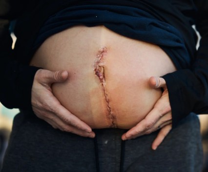 Close-up of a pregnant stomach with a long, stitched incision vertically through the center