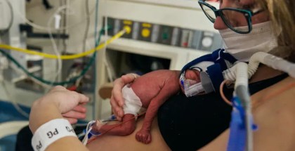 Person with a premature infant on their chest in a hospital setting. The baby is wearing a diaper, and has tubes and a ventilator