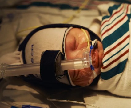 Close-up on the face of a premature baby with a ventilator tube