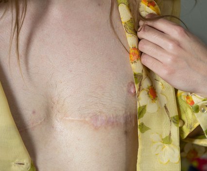 AT LAST: Samuel Kulovitz reveals the scars from his breast removal surgery. After the procedure, “I finally felt right in my body,” he said. REUTERS/Mikala Compton