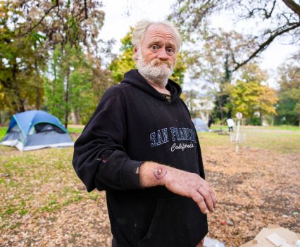 Man showing what appears to be a drug related injury on his hand