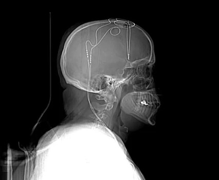 CT scan of electrodes in a person's brain